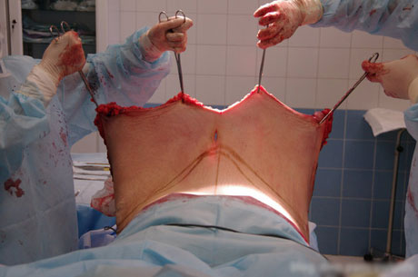 丰胸手术 恐怖图片